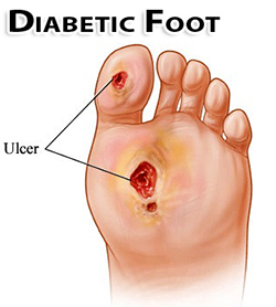 Diabetic foot