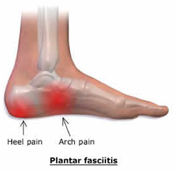 Plantar Fasciitis