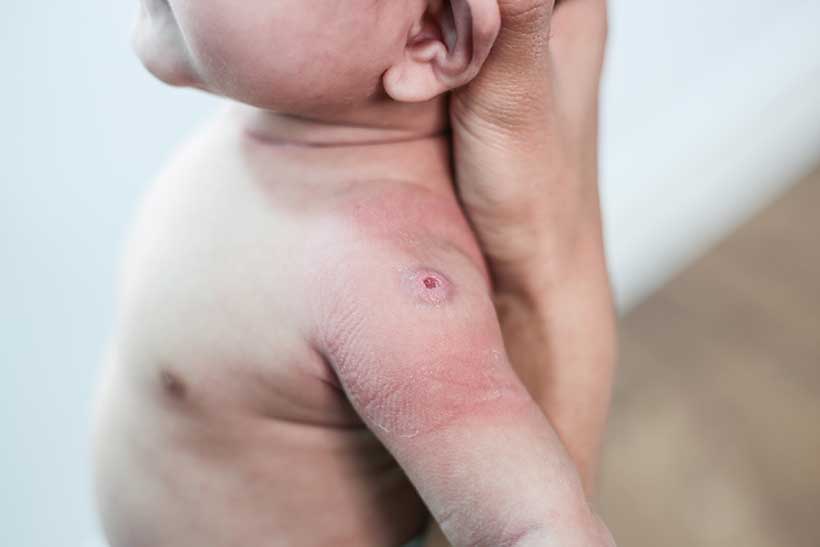 Smallpox Vaccine Scars